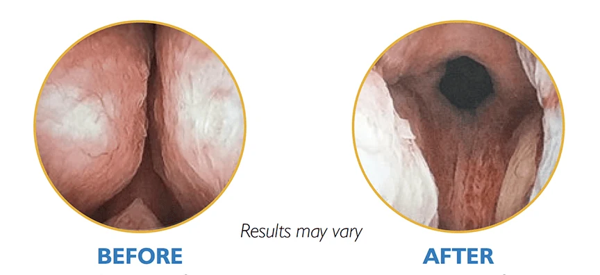 Prostate scan before and after treatment